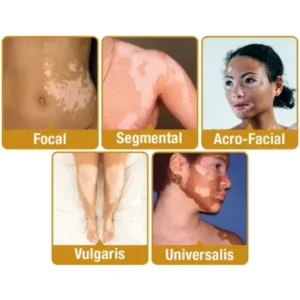 LOVILDS™ BeeVenom Vitiligo Treatment Cream