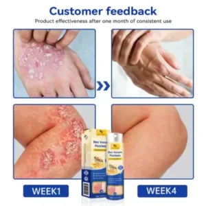 LOVILDS™ PsoriaHeal Psoriasis Spray Pro