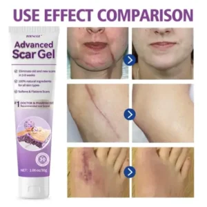 Zoencgz™ Advanced Scar Gel