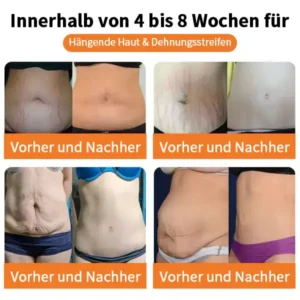 AAFQ™ Bienenvenen-Lymphdrainage-Schlankheitskapseln