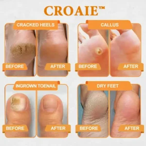 CROAIE™ Bee Venom & Herbal Slimming Foot Patches for Lymphatic Support and Blood Sugar Balance - Natural Swelling Reduction & Detox