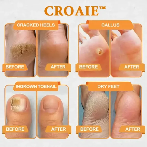 CROAIE™ Bee Venom & Herbal Slimming Foot Patches for Lymphatic Support and Blood Sugar Balance - Natural Swelling Reduction & Detox