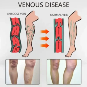 Ceoerty™ Varicose Veins Relief Oil