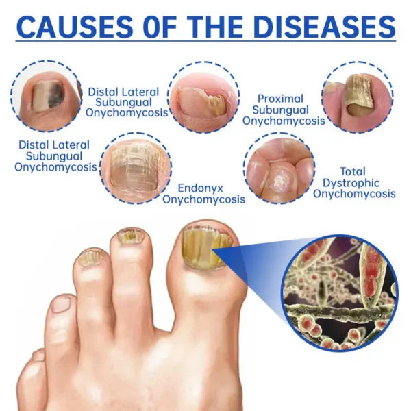 Furzero™ PureNail Fungus Laser Device