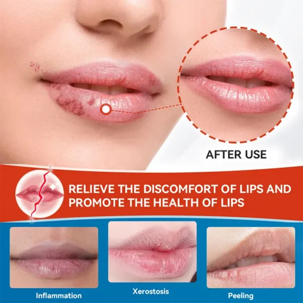 LIMETOW™ Cheilitis Cream