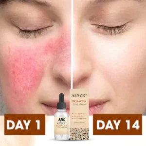 AEXZR™ Rosacea Cure Serum