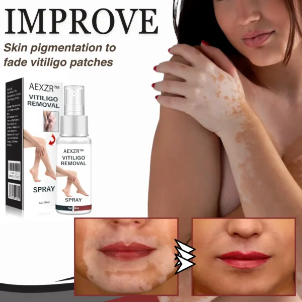 AEXZR™ Vitiligo Removal Spray