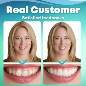 EzySmile™ SnapOn Silicone Veneers