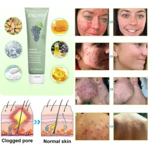 Purifying Exfoliating Gel for Acanthosis Nigricans