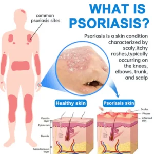 Cvreoz® Magnesium Herbal Psoriasis Spray ⚕️ FDA Certified