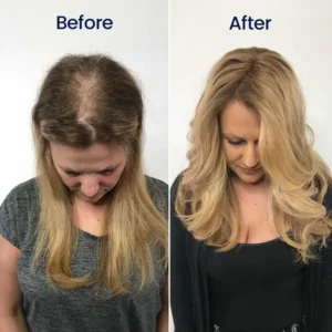 Neslemy® Maximum Strength 5% Minoxidil Fast-Action Hair Growth Serum